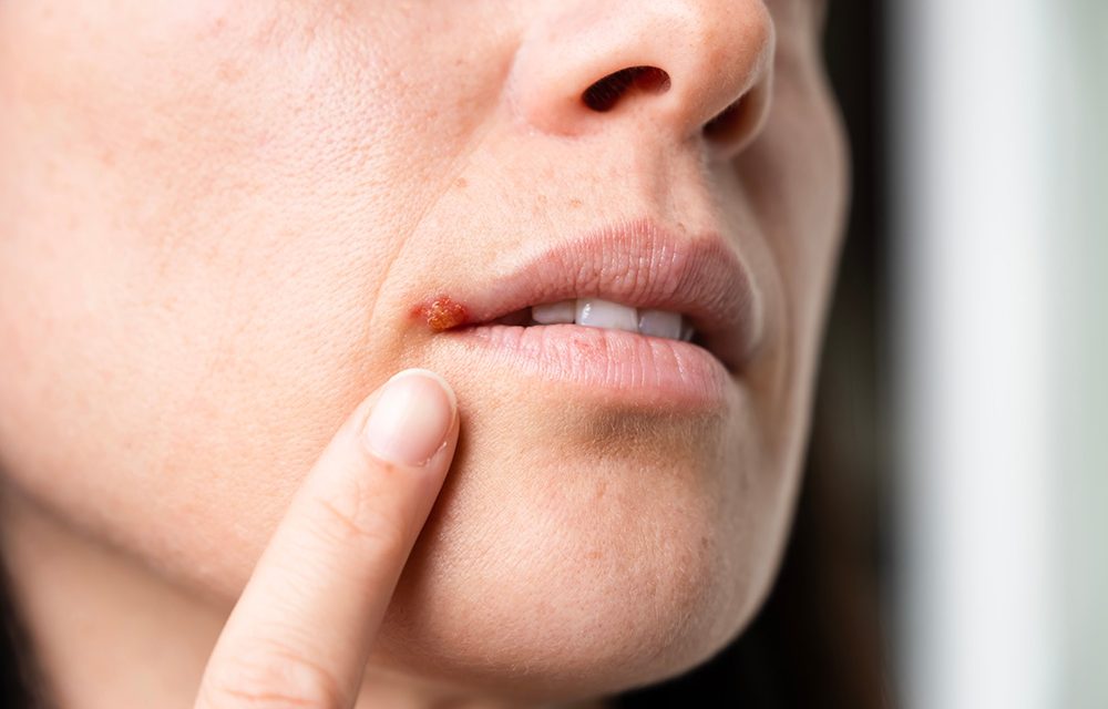 Lippenherpes in der Urlaubszeit