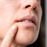 Lippenherpes in der Urlaubszeit