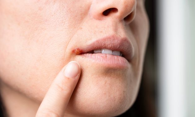 Lippenherpes in der Urlaubszeit