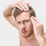 Haarausfall – ein Schicksal der Männer?