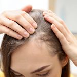 Haarausfall – kreisrunder Haarausfall bei Frauen