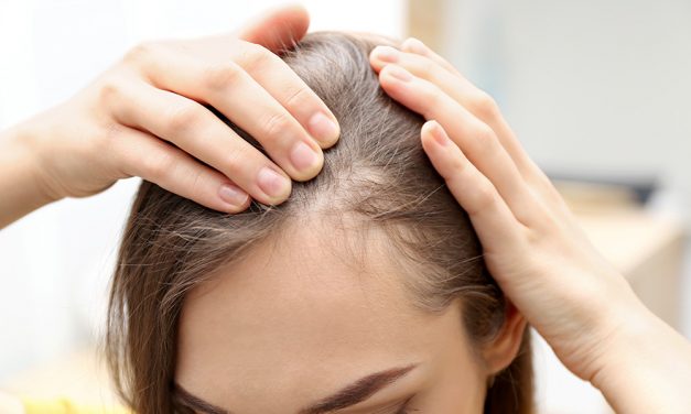 Haarausfall – kreisrunder Haarausfall bei Frauen