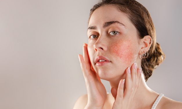 Rosacea – chronische, entzündliche Hauterkrankung
