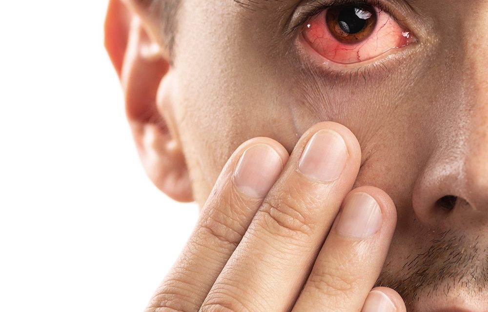 Bindehautentzündung – wenn das Auge rot sieht