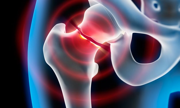 Oberschenkelhalsbruch – medial oder lateral