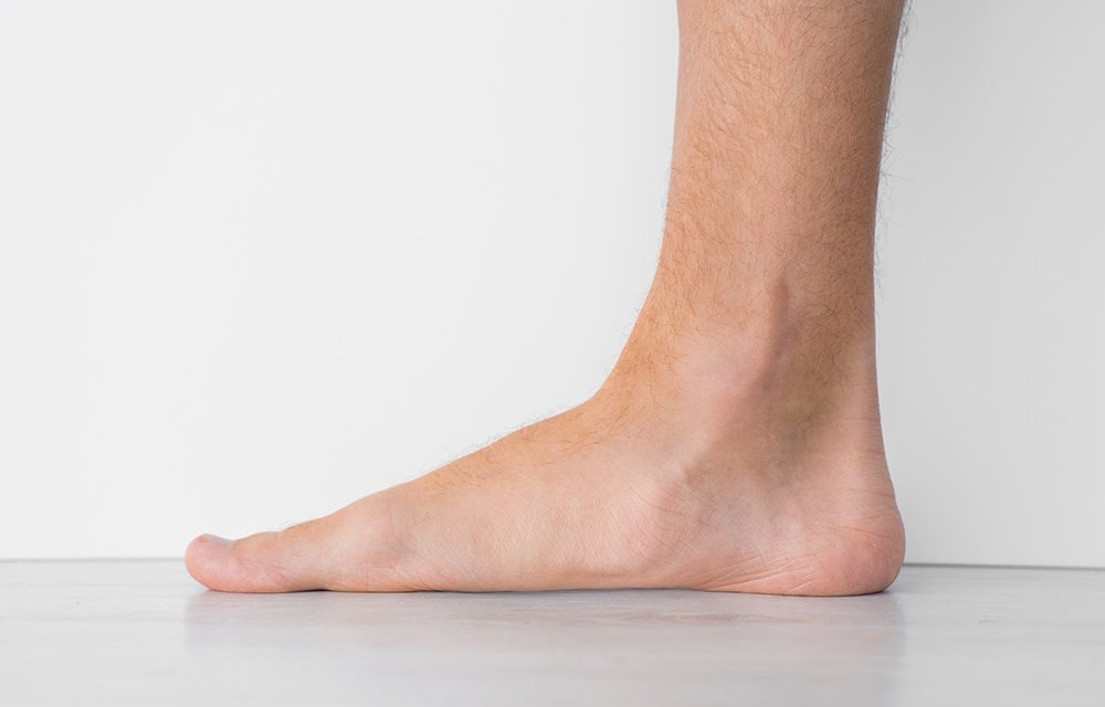 Plattfuß im Schuh – vom Sinn orthopädischer Einlagen